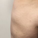Filler Glutei – Complicanze