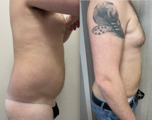 Liposuzione ultrasonica - domande e risposte 