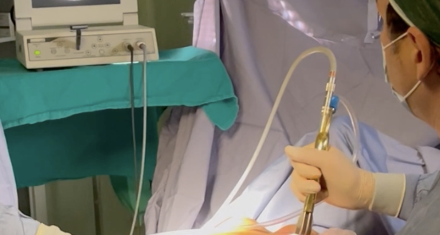 Mastoplastica di preservazione pre-pettorale