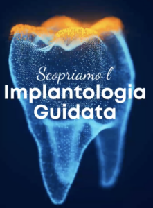 Implantologia mininvasiva guidata