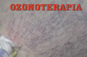 Trattamento dei capillari con Ozono