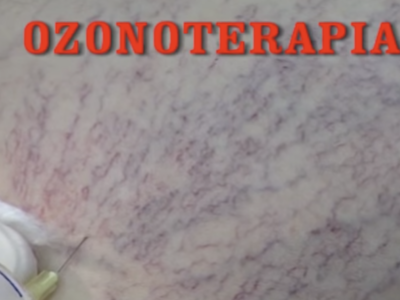 Trattamento dei capillari con l’Ozono