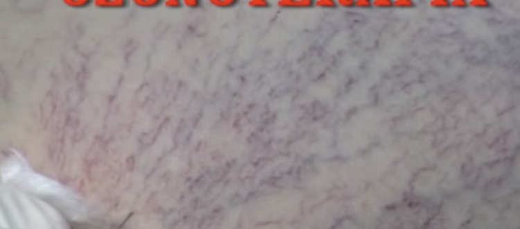 Trattamento dei capillari con l’Ozono