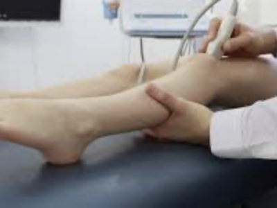 Fleboterapia Trap – Trattamento delle vene varicose