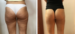 Lipoemulsione Cutanea a Fibra Ottica