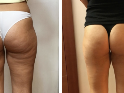 Lipoemulsione Cutanea a Fibra Ottica