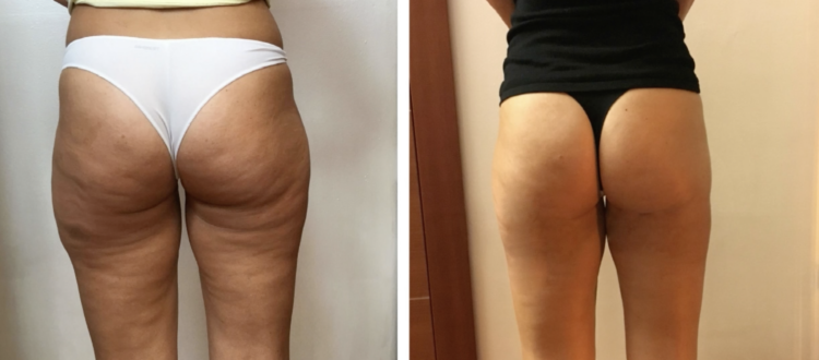 Lipoemulsione Cutanea a Fibra Ottica