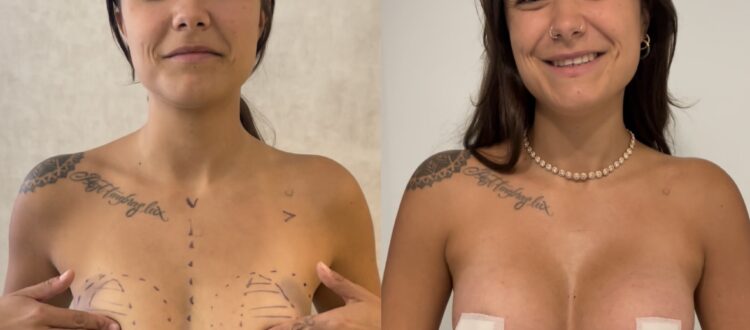 Mastoplastica con Preservè Motiva - L'esperienza di Laura