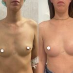 Mastoplastica mininvasiva a Seregno – Monza