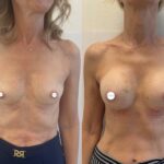 Mastoplastica mininvasiva a Seregno – Monza