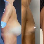 Mastoplastica mininvasiva a Seregno – Monza