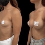 Mastoplastica mininvasiva a Seregno – Monza