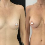 Mastoplastica mininvasiva a Seregno – Monza