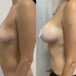 Mastoplastica mininvasiva a Seregno – Monza