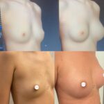 Mastoplastica mininvasiva a Seregno – Monza