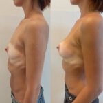 Mastoplastica mininvasiva a Seregno – Monza