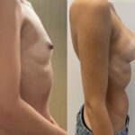 Mastoplastica mininvasiva a Seregno – Monza