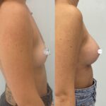 Mastoplastica mininvasiva a Seregno – Monza