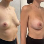 Mastoplastica mininvasiva a Seregno – Monza