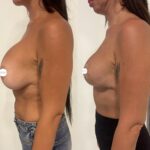 Mastoplastica mininvasiva a Seregno – Monza