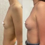 Mastoplastica mininvasiva a Seregno – Monza