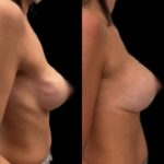 Mastoplastica mininvasiva a Seregno – Monza