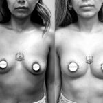 Mastoplastica mininvasiva a Seregno – Monza