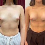 Mastoplastica mininvasiva a Seregno – Monza