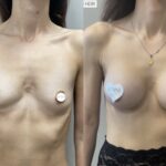 Mastoplastica mininvasiva a Seregno – Monza