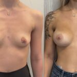 Mastoplastica mininvasiva a Seregno – Monza