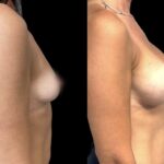 Mastoplastica mininvasiva a Seregno – Monza