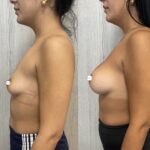 Mastoplastica mininvasiva a Seregno – Monza