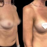 Mastoplastica mininvasiva a Seregno – Monza