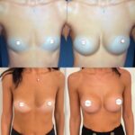 Mastoplastica mininvasiva a Seregno – Monza