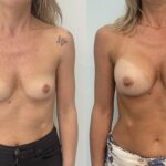 Mastoplastica mininvasiva a Seregno – Monza