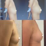 Mastoplastica mininvasiva a Seregno – Monza