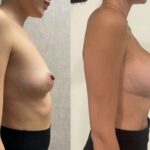 Mastoplastica mininvasiva a Seregno – Monza