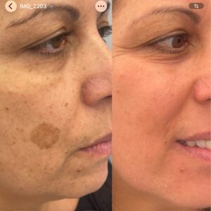 Trattamento delle macchie del volto