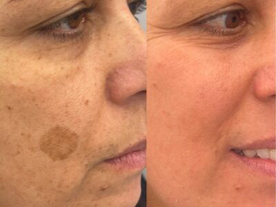 Trattamento delle macchie del volto