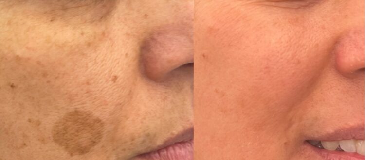 Trattamento delle macchie del volto