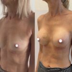 Mastoplastica mininvasiva a Seregno – Monza