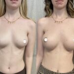 Mastoplastica mininvasiva a Seregno – Monza