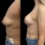 Mastoplastica mininvasiva a Seregno – Monza