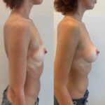 Mastoplastica mininvasiva a Seregno – Monza