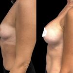 Mastoplastica mininvasiva a Seregno – Monza