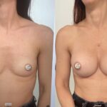 Mastoplastica mininvasiva a Seregno – Monza