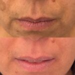 Trattamento delle macchie del volto