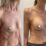 Mastoplastica mininvasiva a Seregno – Monza