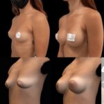 Mastoplastica mininvasiva a Seregno – Monza