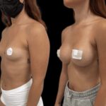 Mastoplastica mininvasiva a Seregno – Monza